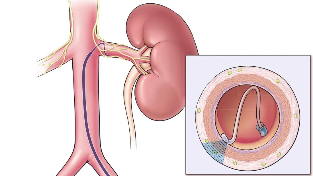 Illustration depicts renal denervation