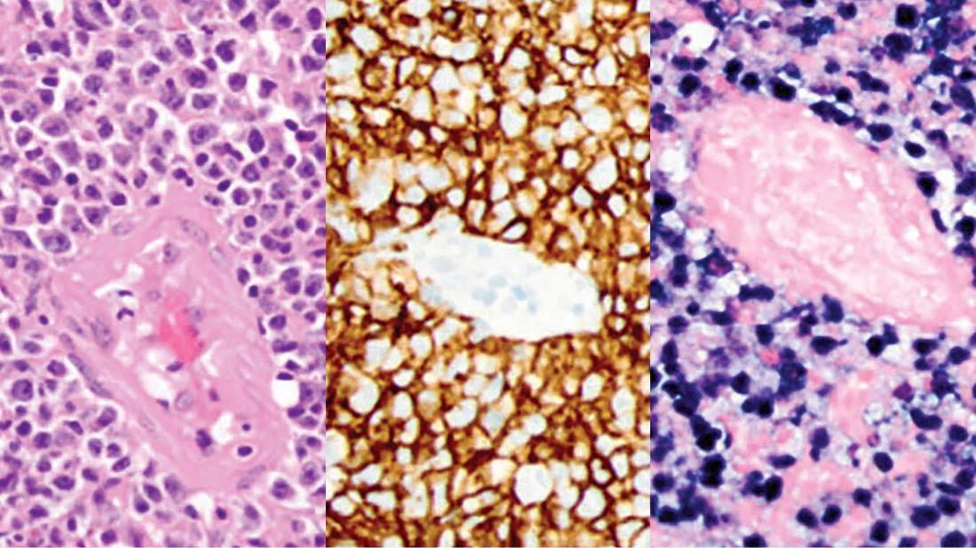 EBV-Associated Lymphoma