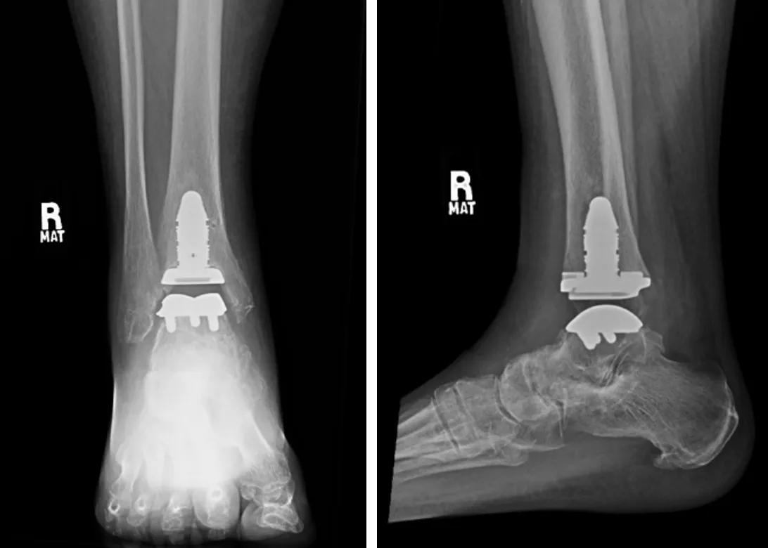 Total ankle replacement