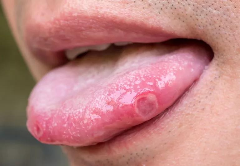 mouth ulcer