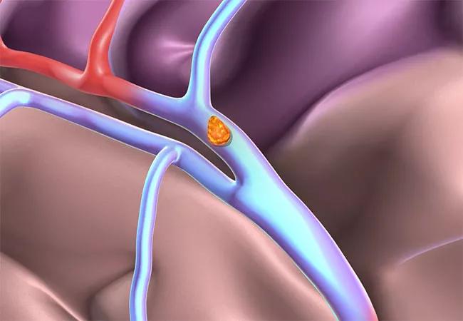 thrombolysis of a clot in ischemic stroke