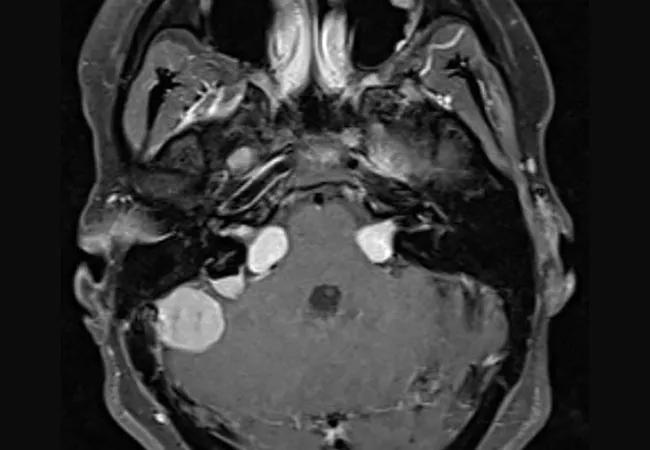 22-NEU-2892117_vestibular-schwannomas-meningiomas_650x450