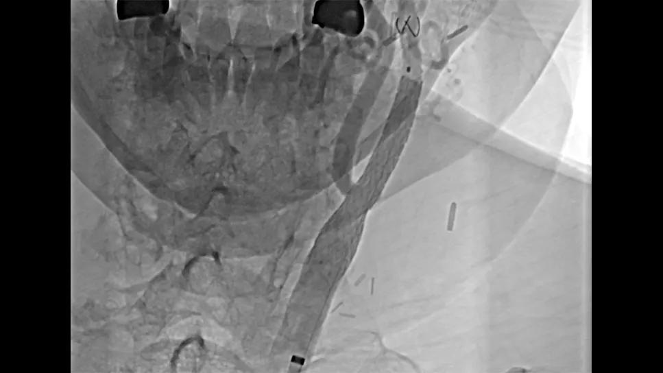 mesh stent in a carotid artery