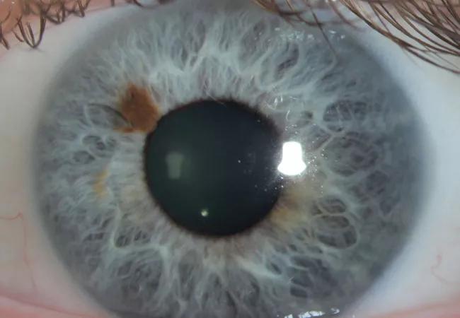 20-EYE-1989584-CQD-Case-study-melanoma-Iris-Hero