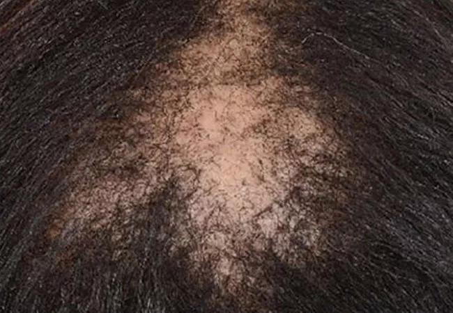 21-PSX-2182108 PART 1_Male and female pattern hair loss_CQD_650x450_Hero-1