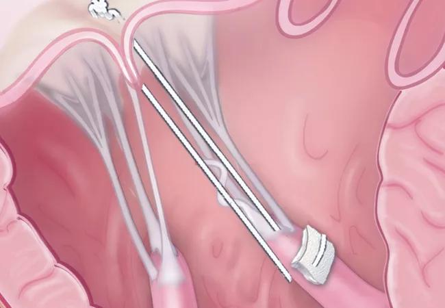 In Degenerative Mitral Valve Repair, Disease Complexity Affects Only Durability, Not Other Outcomes