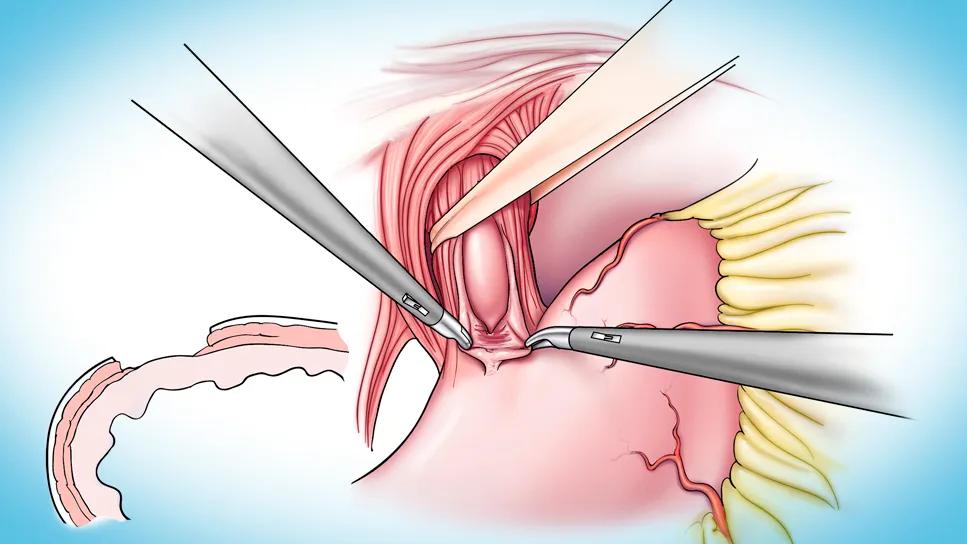 heller myotomy operation