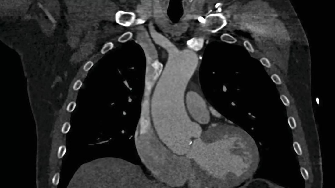 Coronal BAV aorta by CT_enlarged_CMYK