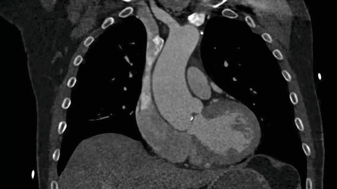 Coronal BAV aorta by CT_enlarged_CMYK