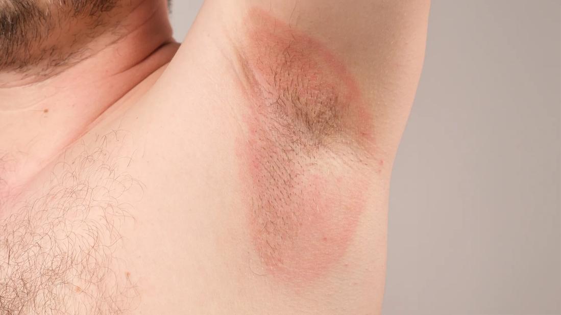 Red and irritated skin on the armpit of a person with their arm raised