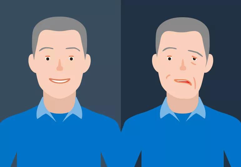 Illustration of Bell's Palsy