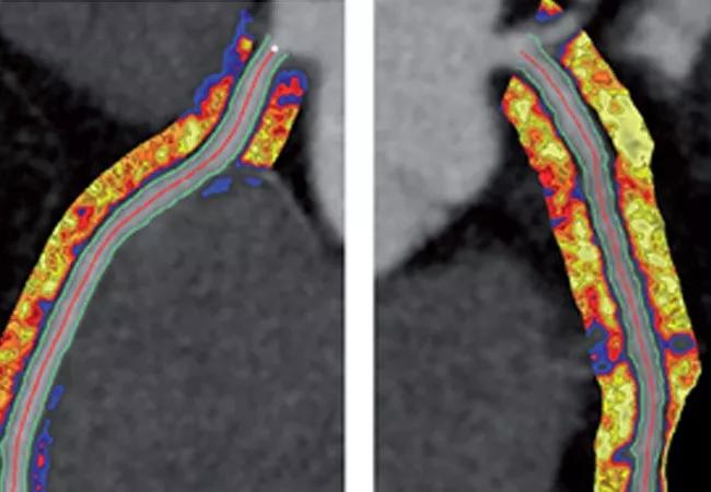 19-HRT-3984-perivascular-fat-650&#215;450