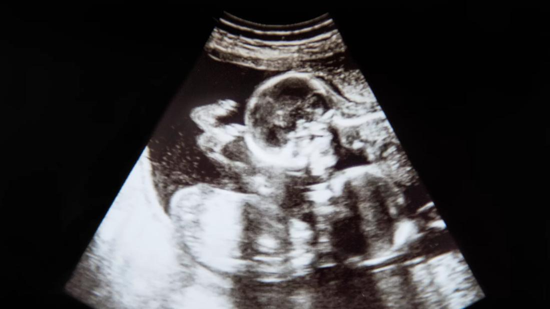 ultrasound of twin pregnancy