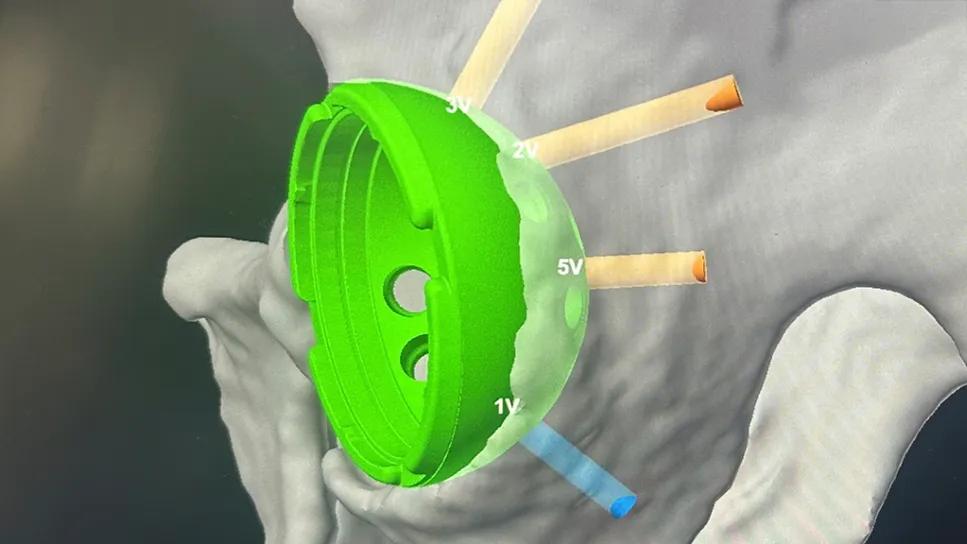 Screen showing robotic planning of hip replacement