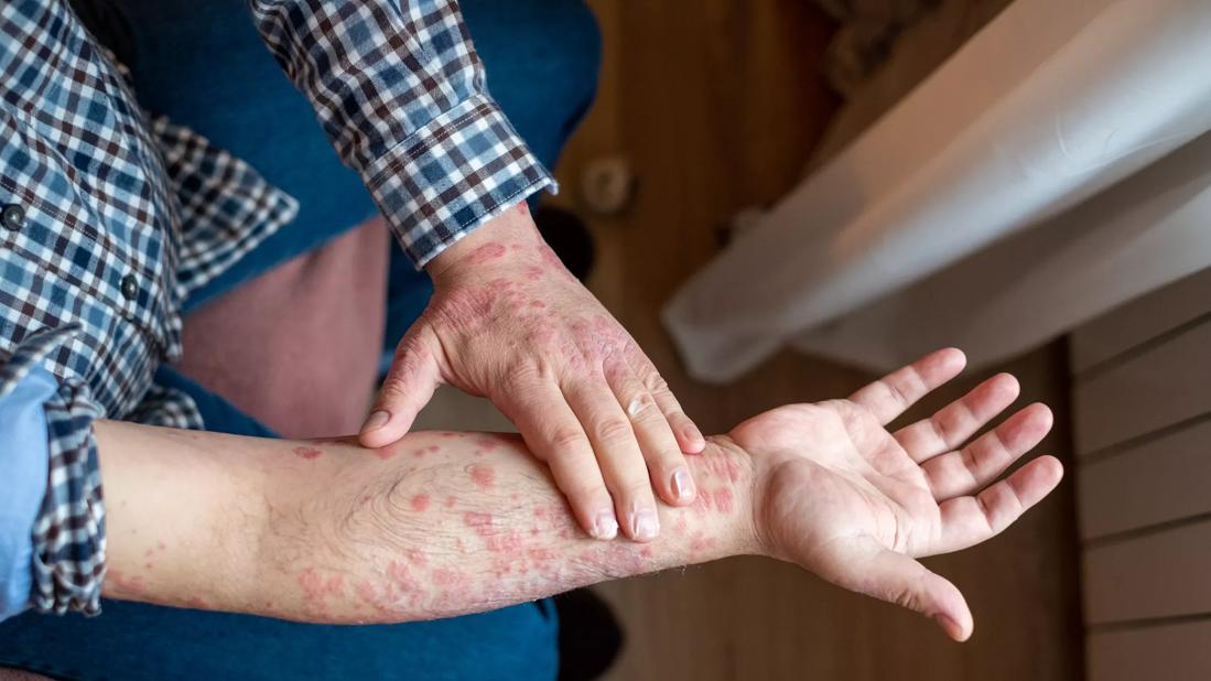 Person examining psoriasis on their arm and hands