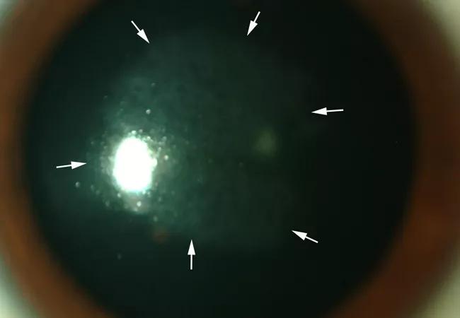 16-eye-2697-corneal-healing-cqd-650