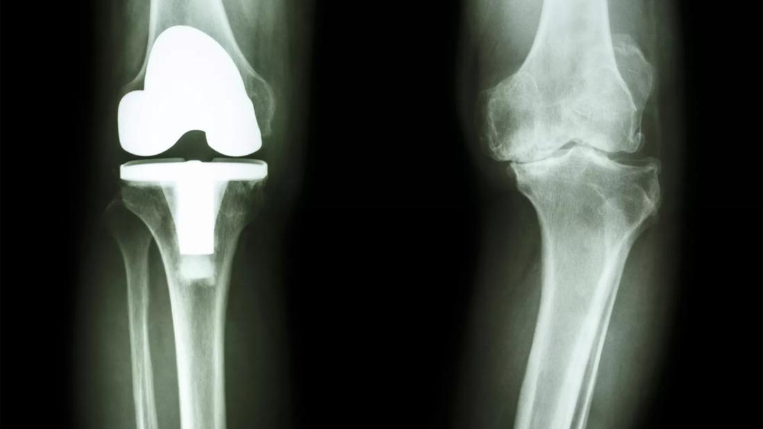 film x-ray of osteoarthritis knee patient and artificial joint