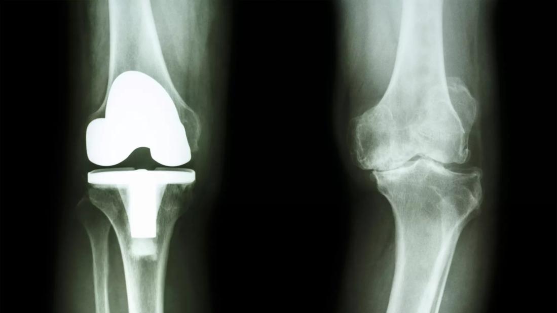 film x-ray of osteoarthritis knee patient and artificial joint