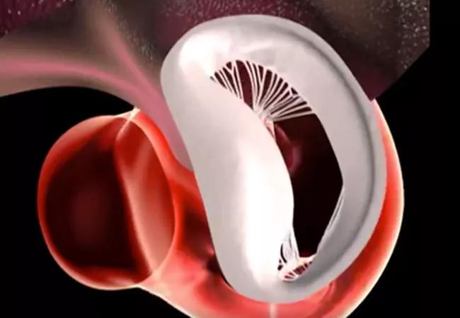 mitral valve regurgitation