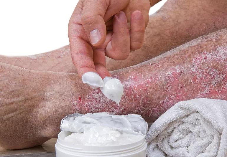 psoriasis home remedy cream