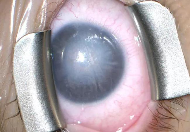 22-EYE-3499812 CQD-Cornea transplant in 1-year-old-Goshe650x450