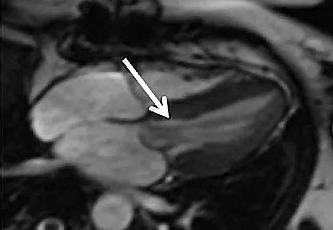 21-HVI-2500367-hypertrophic-cardiomyopathy-650&#215;450