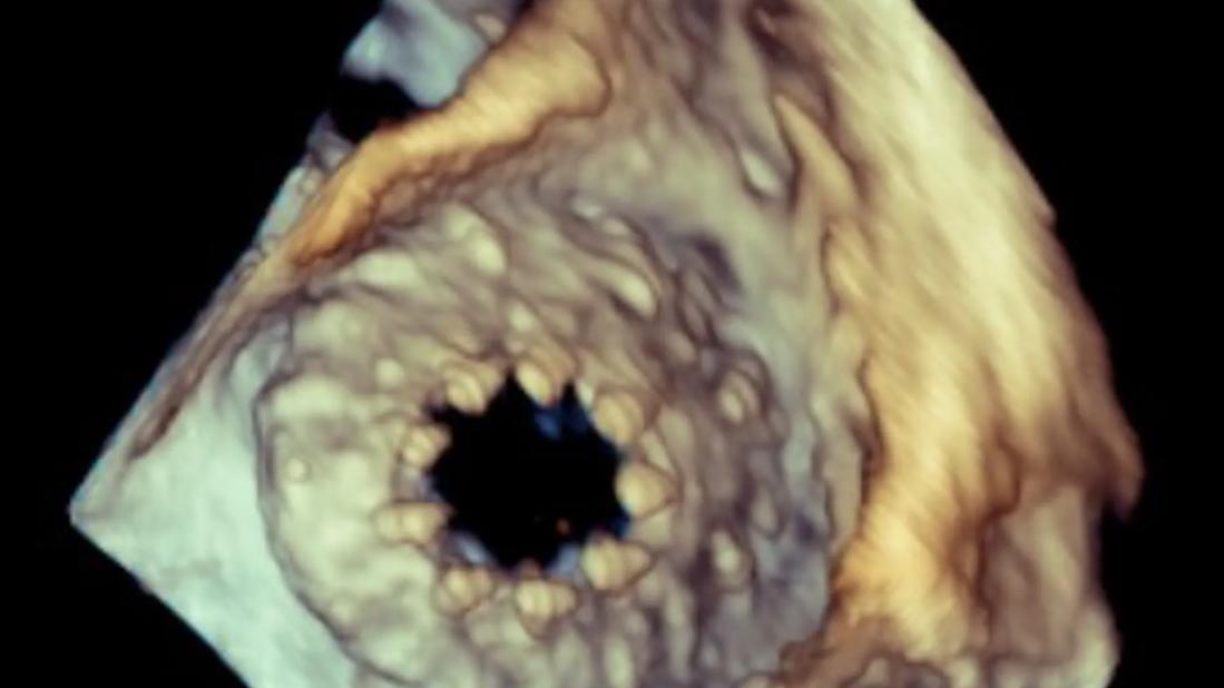 Tricuspid valve after transcatheter replacement