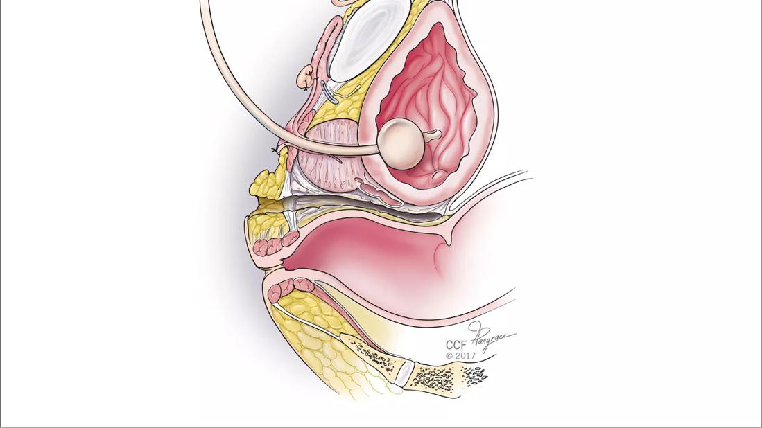 20-WHI-1938960 CQD WHI &#8211; Outcomes of Vaginoplasty Surgery &#8211; Ferrando_CQD Hero_650x450