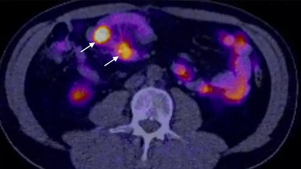 Fluorescent imaging during small bowel surgery