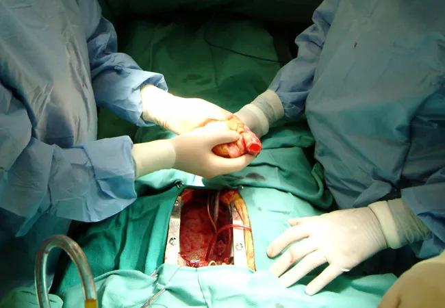 Heart Transplantation