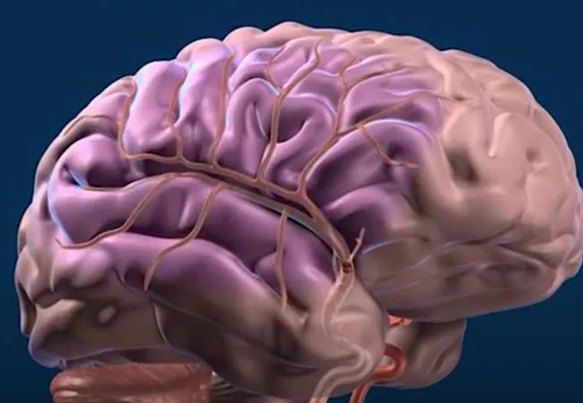 Combo Therapy Stroke Trial Ends One Debate