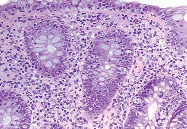 18-DDI-2634-mediatedColitis-650&#215;450