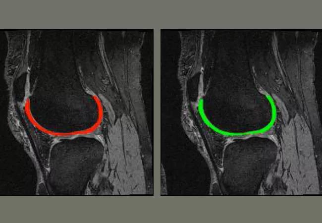 18-ORT-1303-cartilageSegment-_650x450