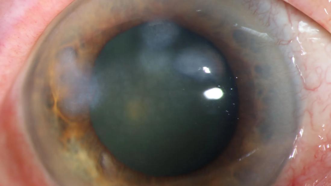 Eye with Salzmann's nodular degeneration