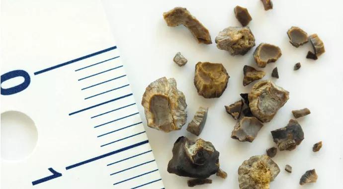650&#215;450-Kideny-Stones