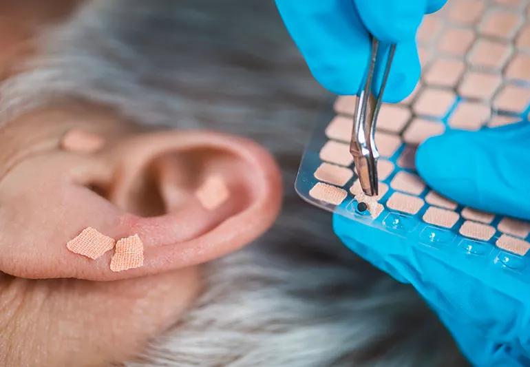 An acupuncturist applies ear seeds, or small latex stickers, to a person's ear.