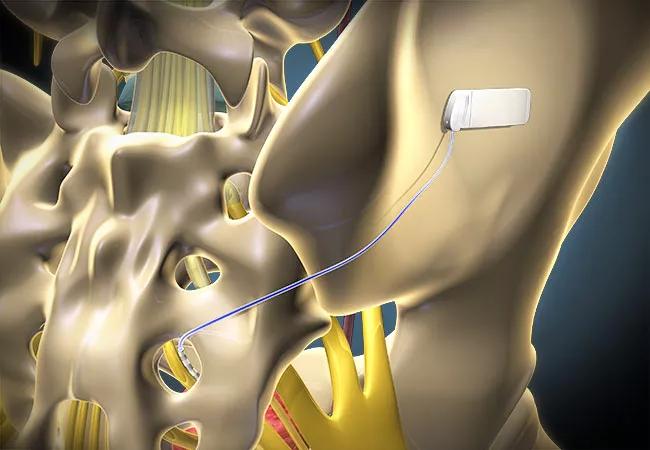 650x450First-Sacral-Neuromodulation-Case-Study