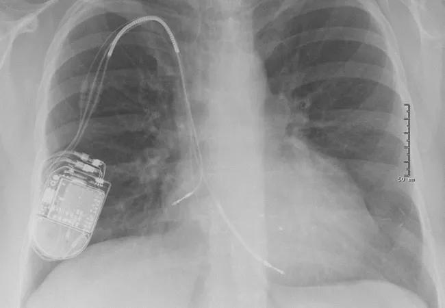 x-ray showing a cardiac implantable electronic device