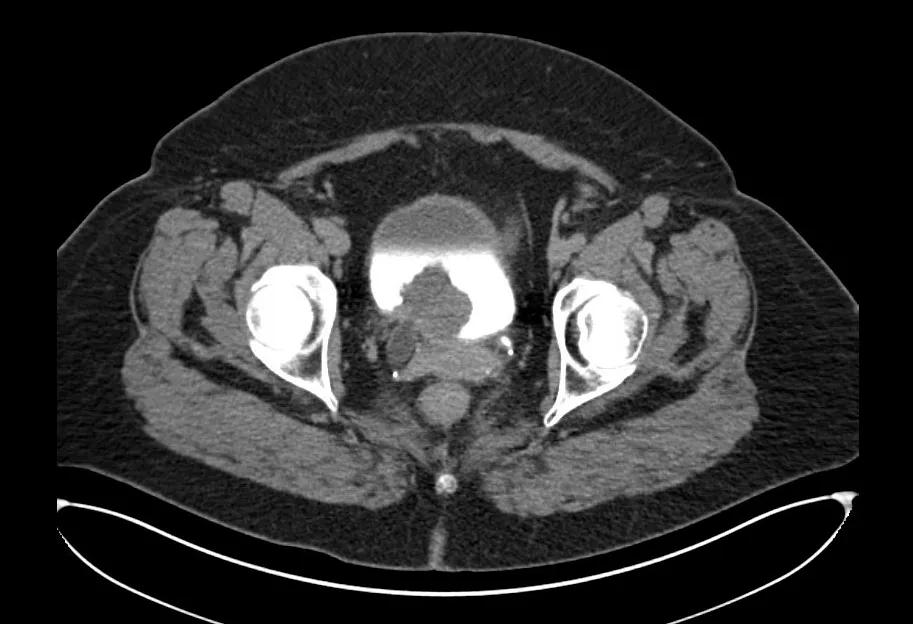 CT scan of female patient bladder cancer