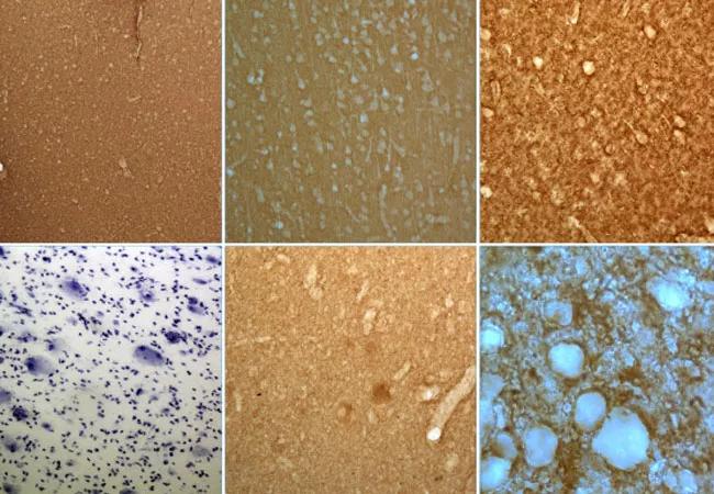 histopathology images showing focal cortical dysplasia