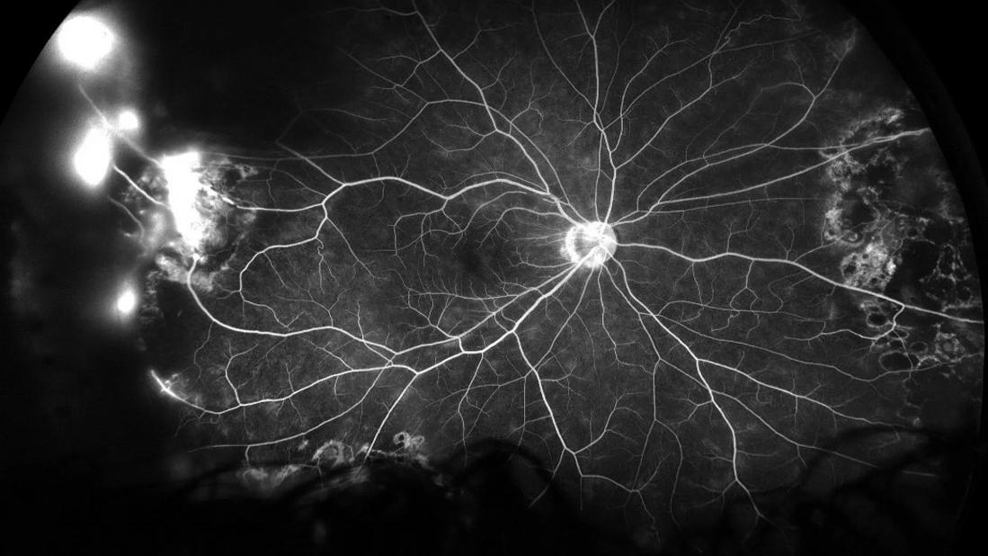 Fluorescein angiography image of leaking blood vessels