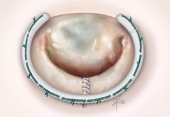 Jeff Loerch mitral valve repair illustration