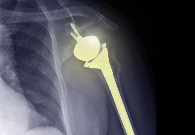 Total shoulder arthroplasty