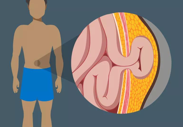 Hernia presenting from the intestines breaching the muscular wall of the stomach showed via a diagram on a person's body.