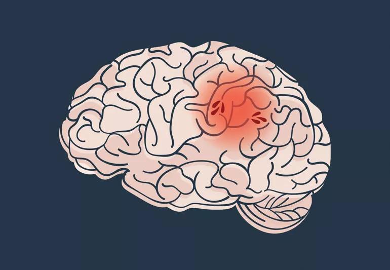 Illustration of brain showing an ischemic stroke episode