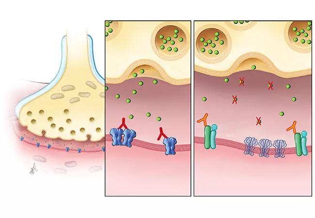 Myasthenia Gravis: Practice and Research Updates (Podcast)