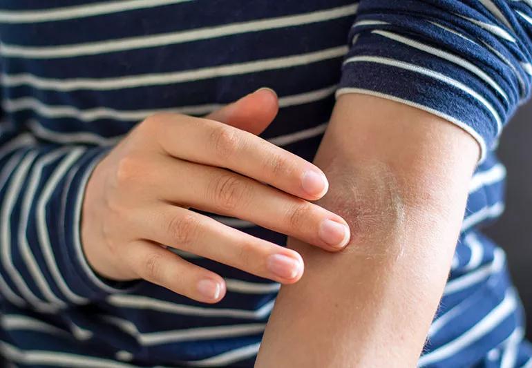 hand applying cream to eczema spot on elbow