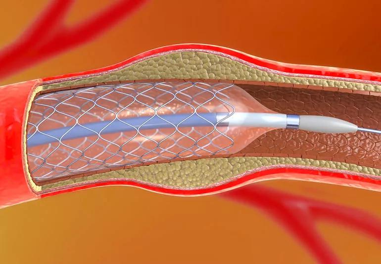 Illustration of a stent angioplasty in a vein