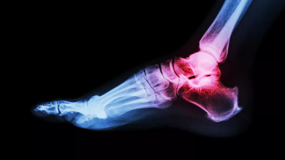 Ankle x-ray