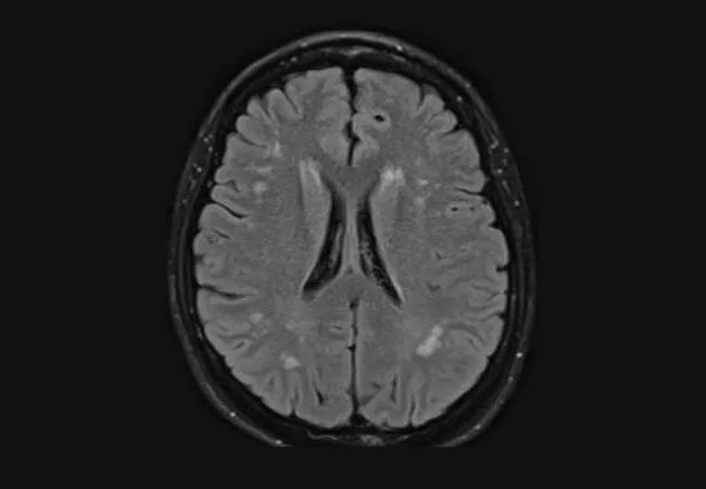 brain MRI hereditary spastic paraplegia